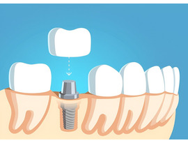 Siiodent Implants: Innovation in Advanced Dental Implant Technology