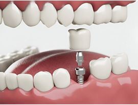 Siiodent Implants: Your Trusted Source for Bulk Dental Implants