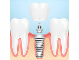 Siiodent Implants: High-Quality Prosthetic Accessories in the USA