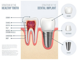 Siiodent Implants for Cost-Effective Bulk Implant Purchases