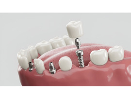Top Dental Implant Kit for Precise Implant Placement