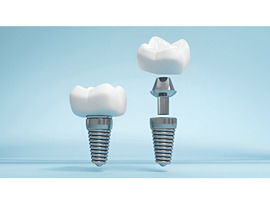 Why Choose HRI Angled Hex Abutment for Implants
