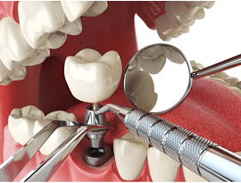 Best Dental Implant Kit for Complete Treatment Solutions