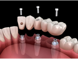 Reliable Dental Instruments Suppliers for Professionals