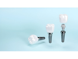 Best HRI Angled Hex Abutment for Optimal Performance