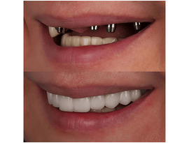 High-Quality Dental Instruments Suppliers for Dentists