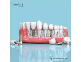 Reliable Dental Implant Manufacturers in Mexico for Clinics