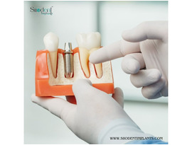 Top Trusted Dental Implant Manufacturers in Mexico for Clinics