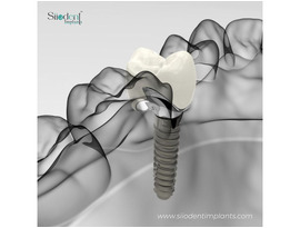 Best Dental Implant Brands in Paraguay | 2025 Ranking
