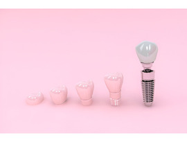 Dental Abutment: Key to Long-Term Implant Success