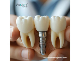 Top-Rated Best Dental Implants Brands in Nicaragua